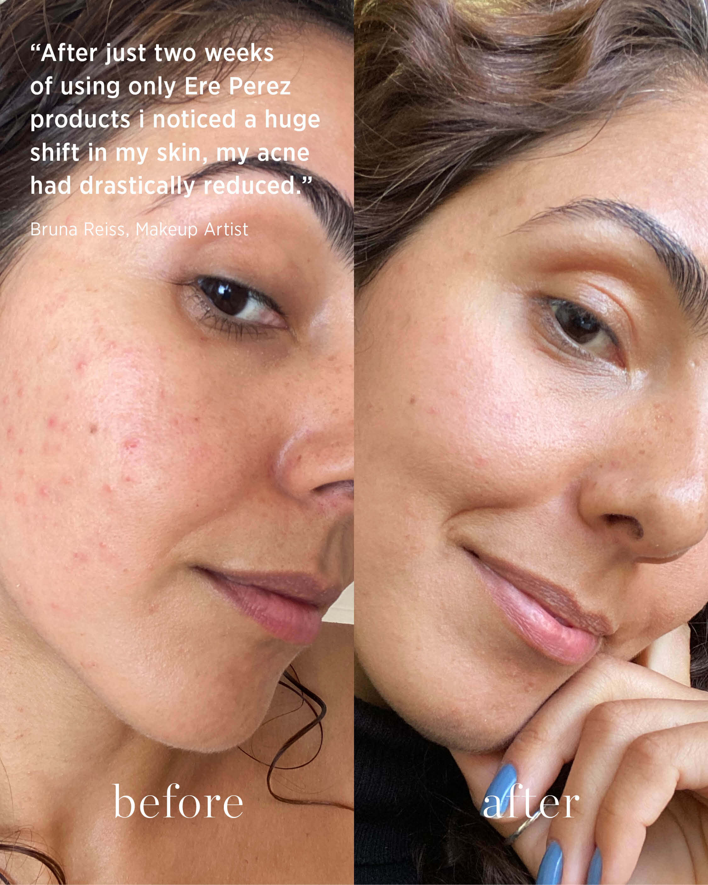comparison and review after usage of clear skin set on acne prone skin