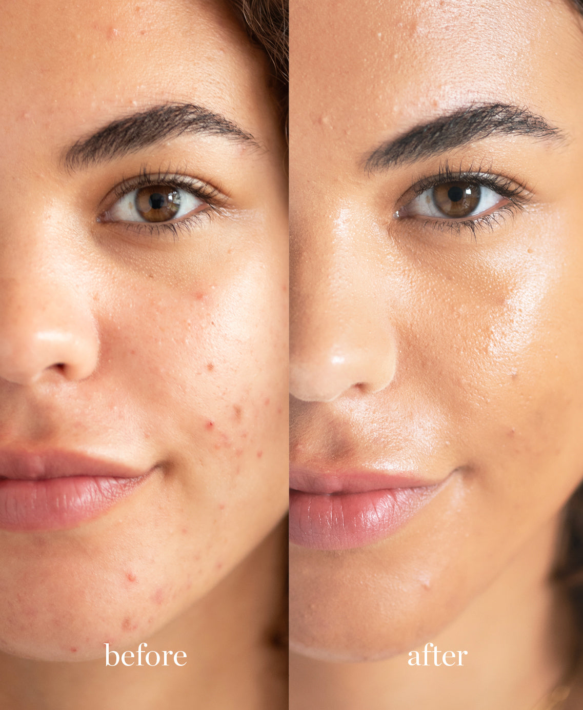 Coverage comparison of nourishing lychee creme corrector applied on the skin giving a clear and even complexion